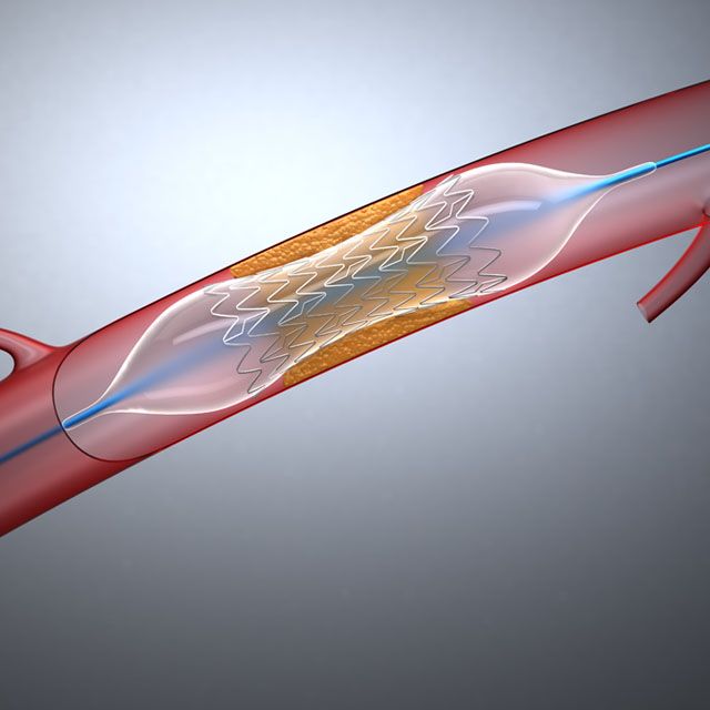 심장 스텐트 (Stent)